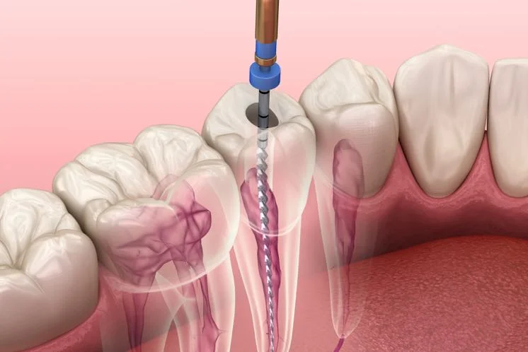 imagen de Endodoncia
