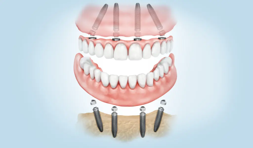 imagen de Implantología