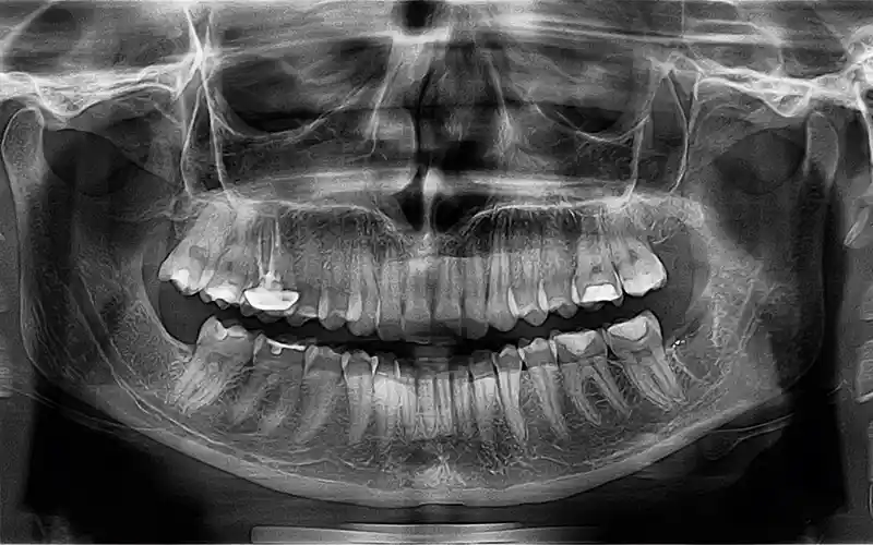 imagen de Tac 3D una sola arcada